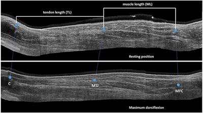 Joint and Muscle Assessments of the Separate Effects of Botulinum NeuroToxin-A and Lower-Leg Casting in Children With Cerebral Palsy